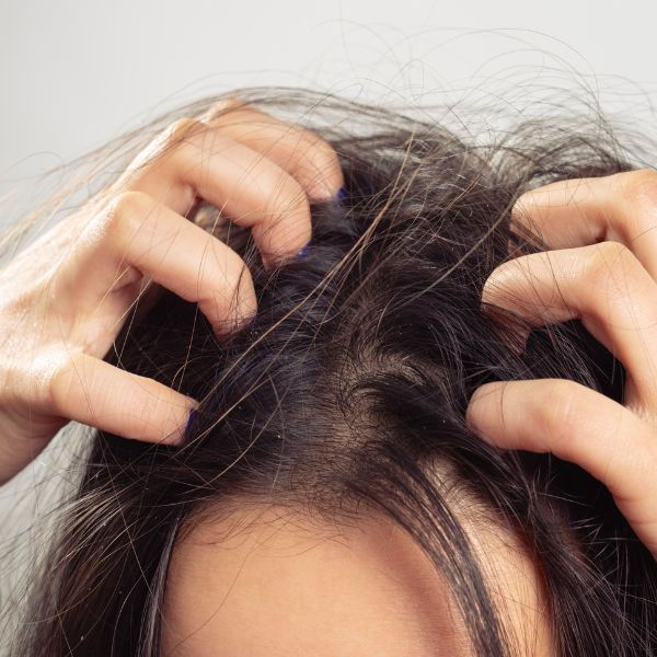 Gãi mạnh còn làm tổn thương da, kéo đứt sợi tóc và dễ gây viêm nang lông