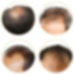 Using hair growth products provides fast and direct results, but you should thoroughly research and use reputable products to avoid unwanted side effects.