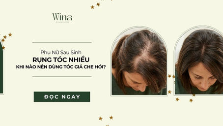 Phụ Nữ Sau Sinh Rụng Tóc Nhiều: Khi Nào Nên Dùng Tóc Giả Che Hói?
