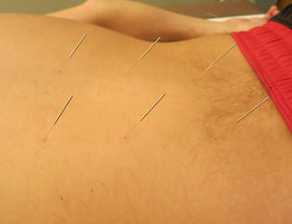 acupuncture in Wilmington, NC