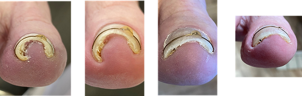 Nagelspange
