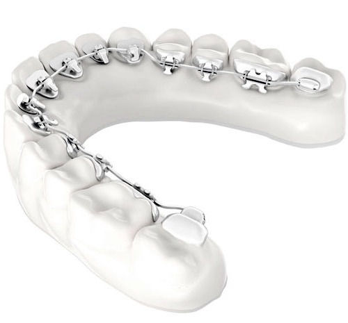 LaBeau - Orthodontie à Bruxelles