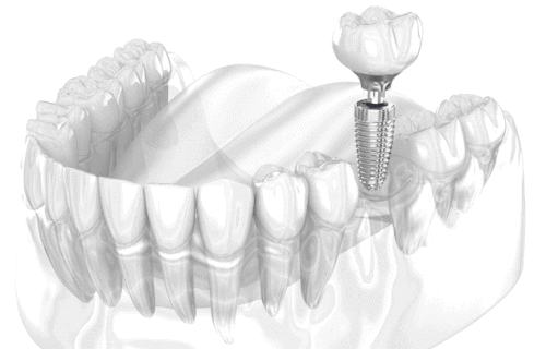 Cabinet stomatologic AKIDENT Bucuresti - Implant complet procedeu