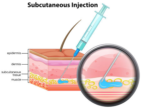 Subcutaneous Injections-- less painful, and more effective?