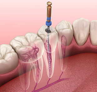 endodonzia.jpg
