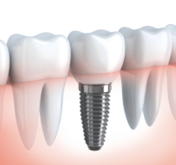 Dental Implant