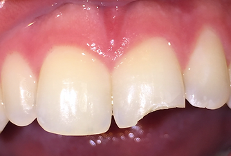 Taunton Cosmetic Dentistry Before