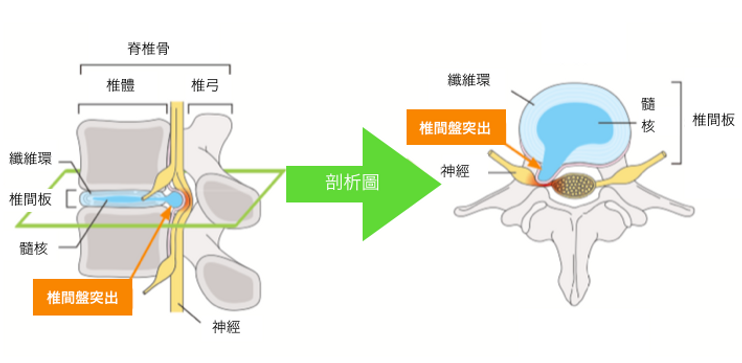 椎間盤突出.png