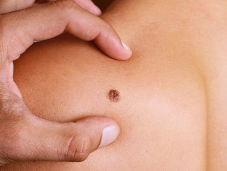 Vamos falar sobre o MELANOMA!
