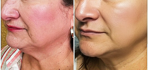 Neck, jawline and cheek endolift