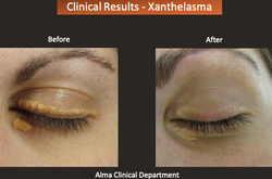 Xanthelasma correction Laser