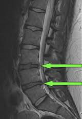 Worsening Trends in the Treatment of Back Pain