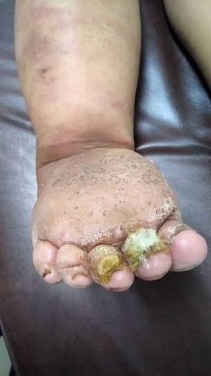 Lymphatic filariasis-related lymphoedema