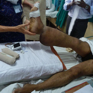 lymphoedema in India