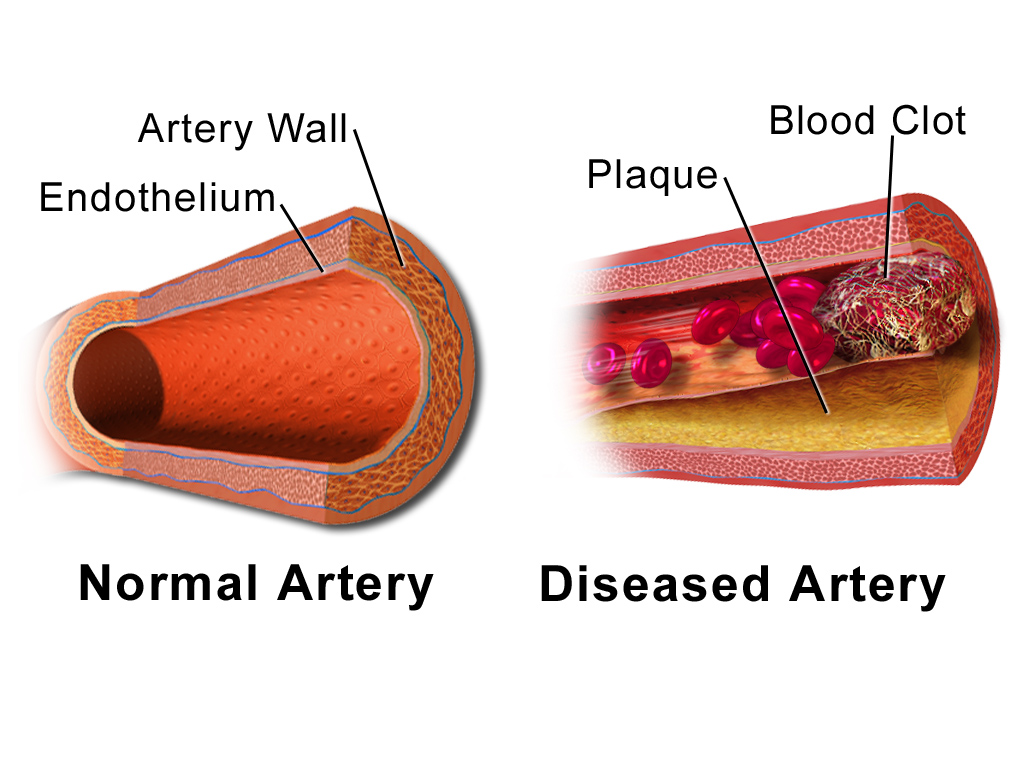 REWIND dulaglutide artery cardiovascular prevention | DietApp.com GLP1 Tracker