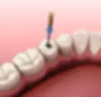 root canal treatment 4