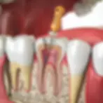endodontics