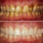 teeth whitening new