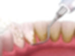 Teeth Whitening