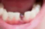 dental implants 4