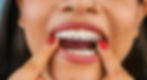 invisalign aligners img 1