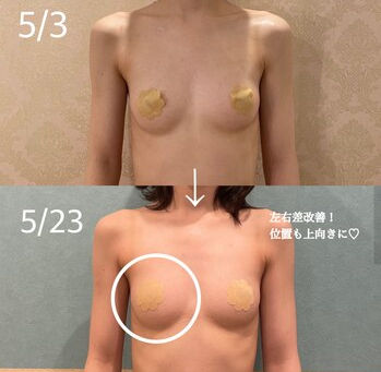 バストの左右差改善!/バストアップ効果