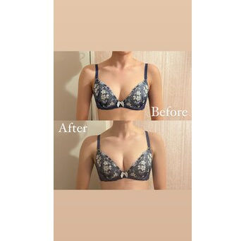 お客様症例写真/一回でのバストの施術効果♪