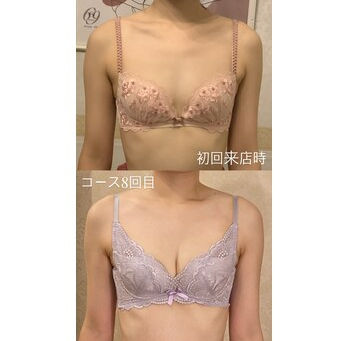 谷間形成/症例写真