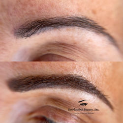 brow correction