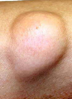 LARK Dr Lévy Dermatology Beauty Treatment - Lipoma Removal
