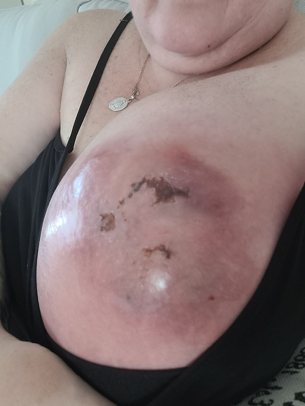 August 1 - 10 days after biopsy (4:00pm)