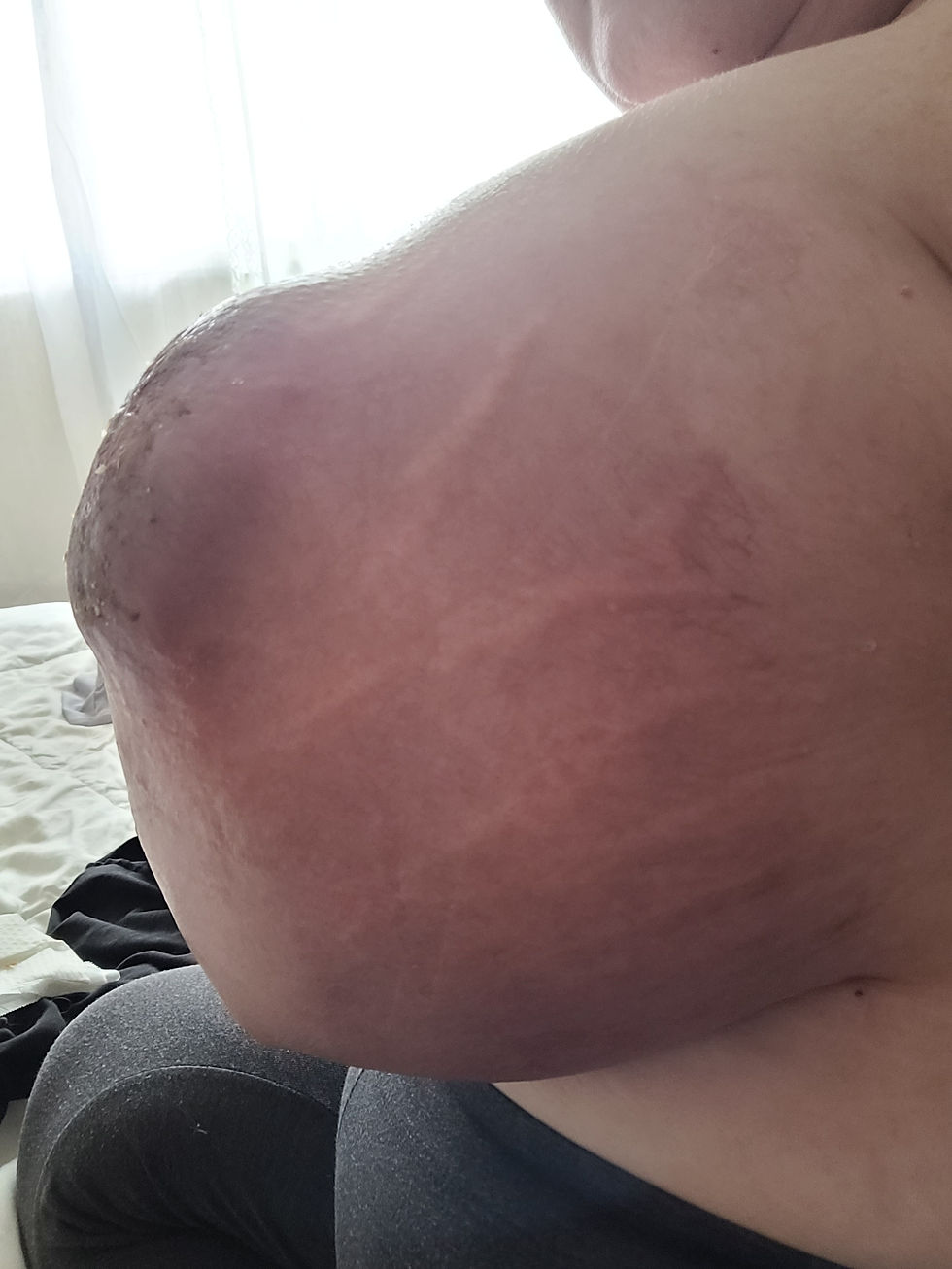 You can see in this pic how the cyst had "popped" and how stretched I was (Taken August 9)