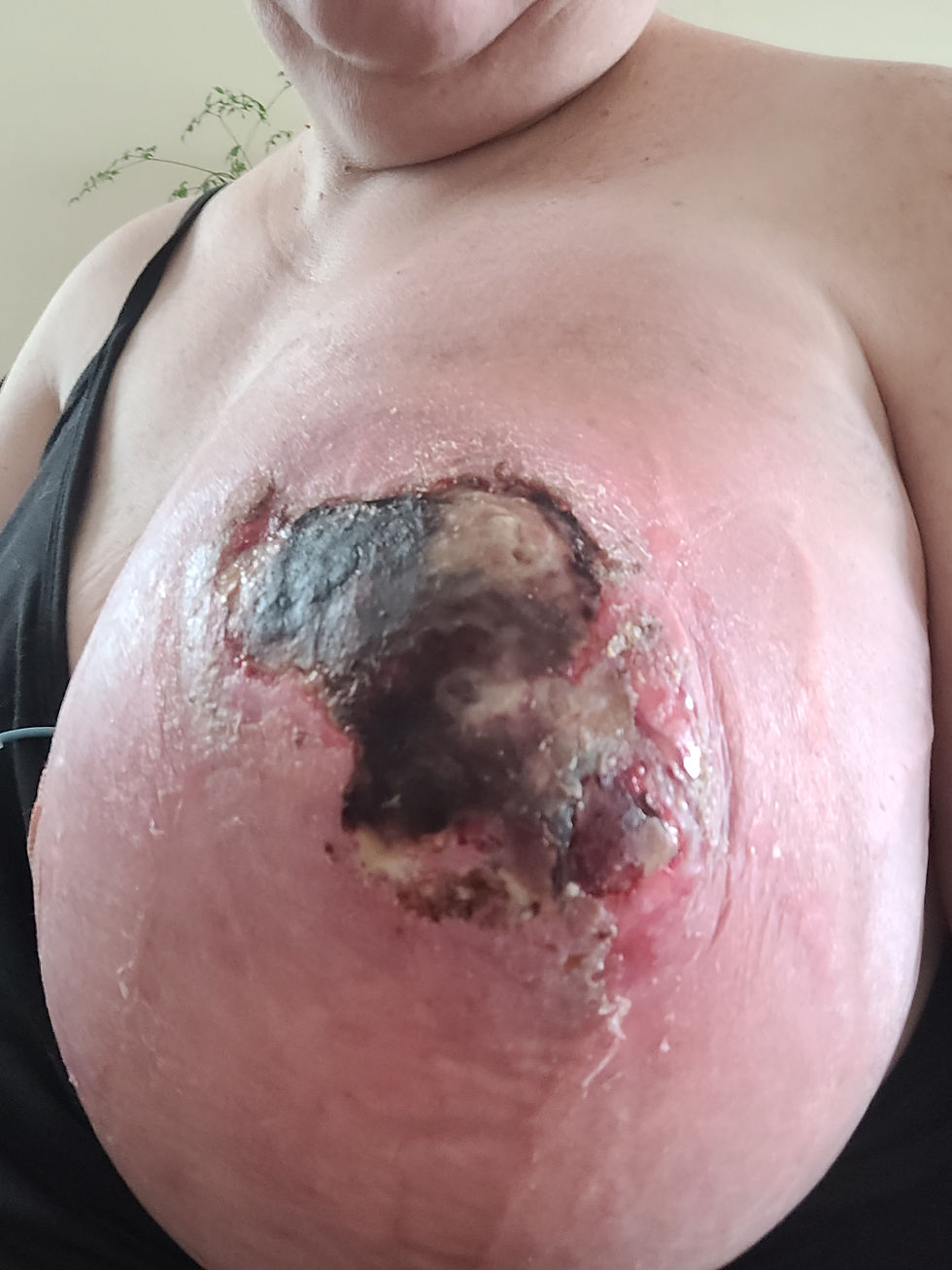 This was taken the day AFTER my drain was put in and AFTER 5.5litres of fluid was removed.