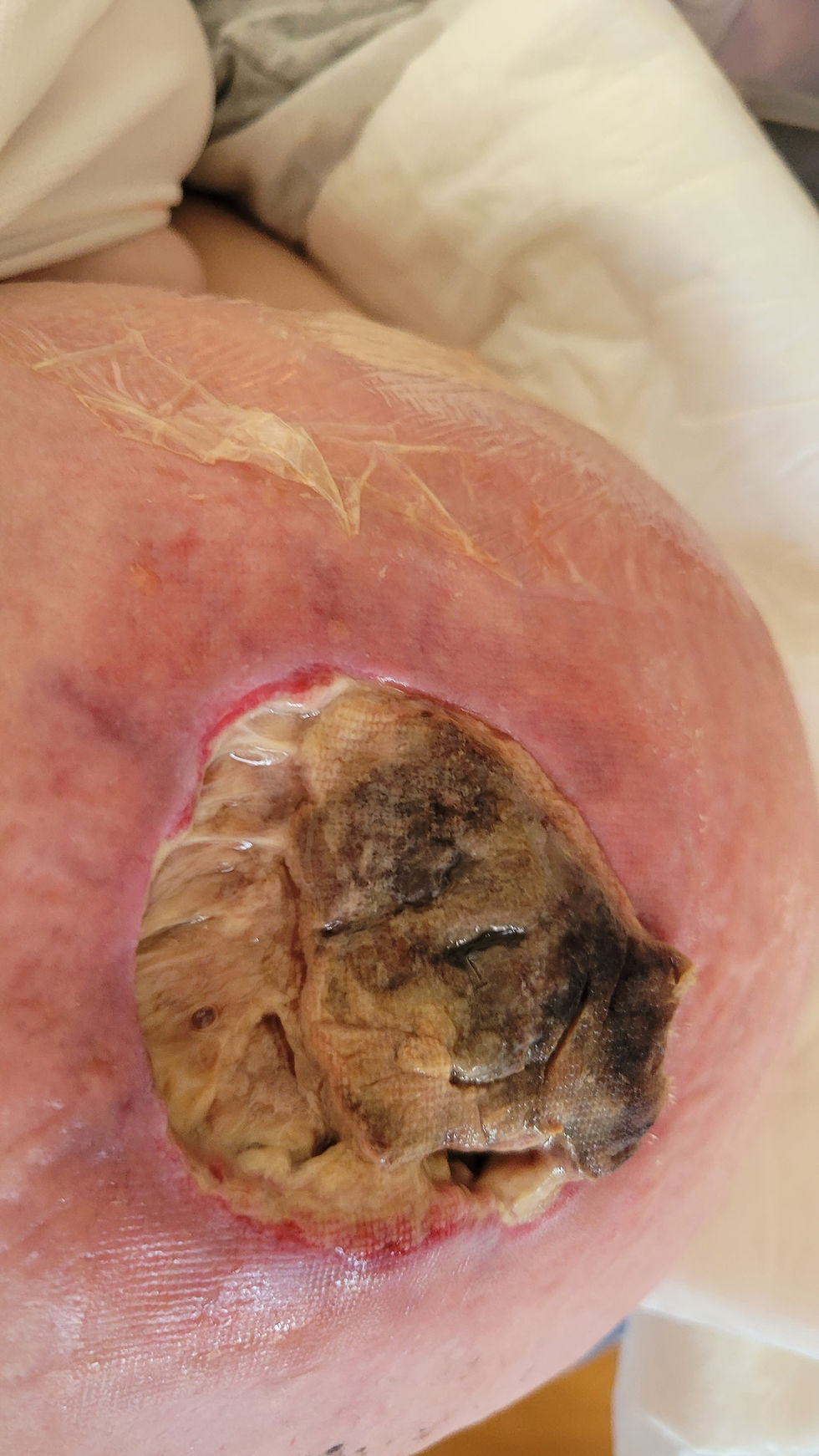 The grid patterns are from a specialized gauze the nurses were using to keep this thing intact and clean (Taken August 26)