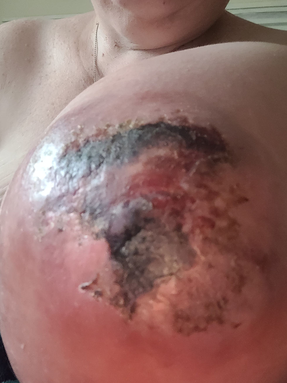 This was taken August 9 - 3 days before I saw Dr. Lesniak so it looked a bit worse than this when I saw him