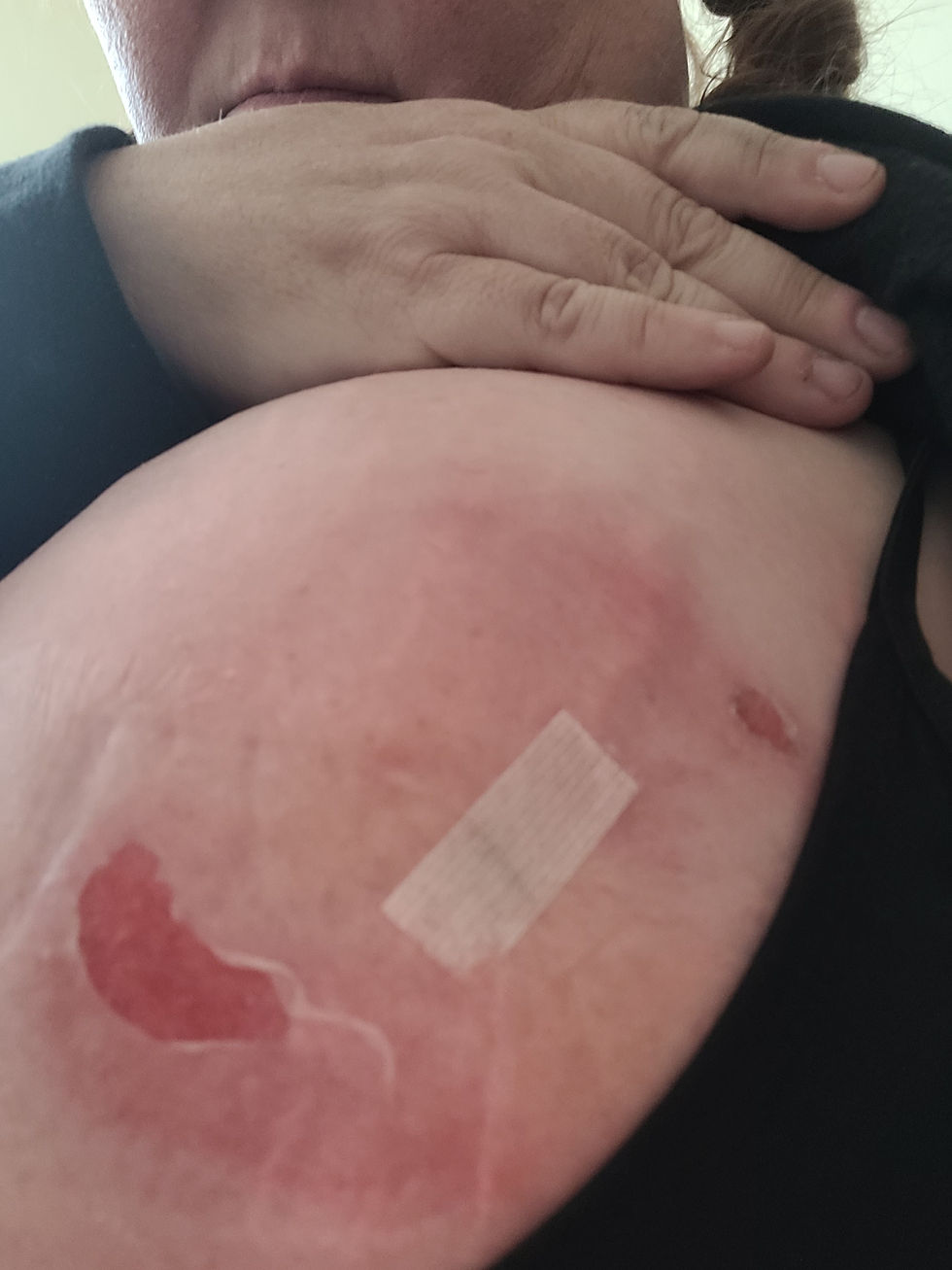 This was taken June 7 - 2 days after the aspiration