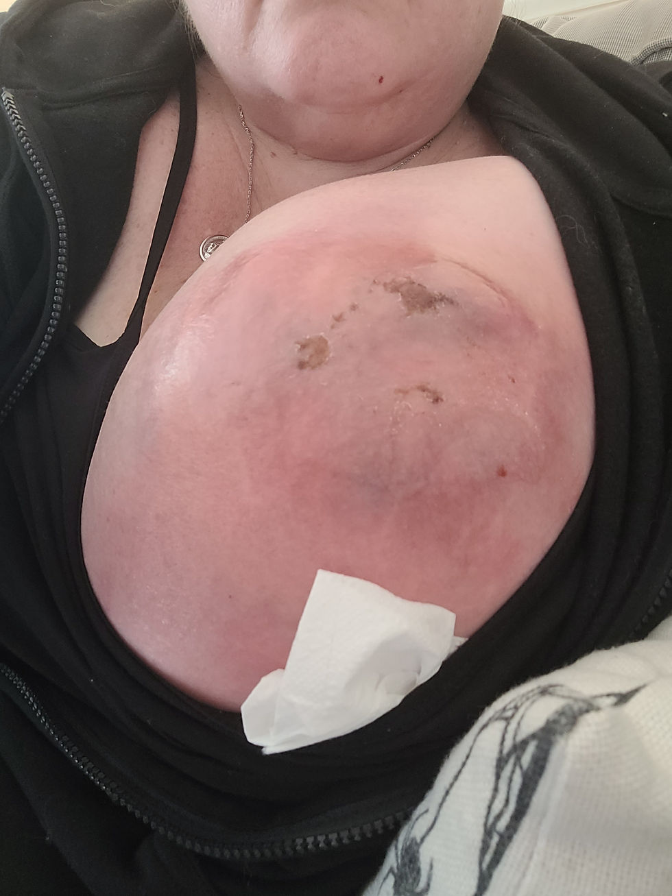 August 1 - 10 days after biopsy (9:58am)