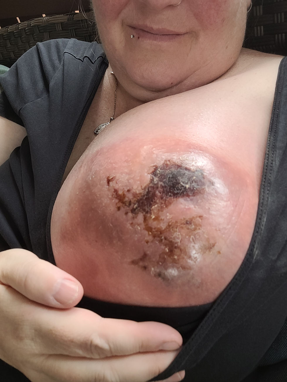August 3 - 13 days post biopsy (2 days before my Lymph node Biopsy)