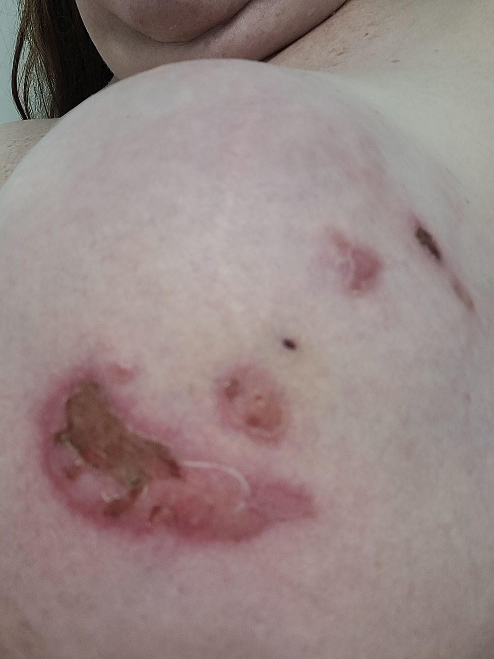 This was June 10, the day after I saw Dr. Gafar. I was on antibiotics for 10 days. You can see how much more swollen I got in just a few days