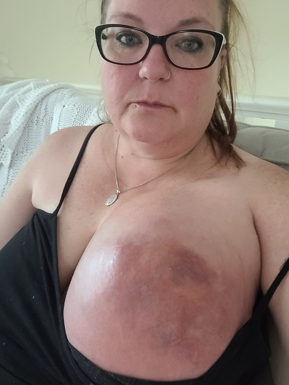 July 30 - 9 days after my biopsy (and 2 litres being drained)