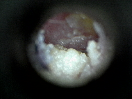 What are the risks of seeking help from an unqualified clinician for earwax microsuction