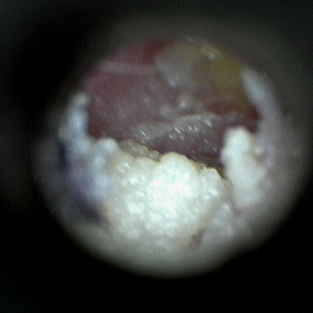What are the risks of seeking help from an unqualified clinician for earwax microsuction