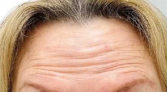 wrinkle_before.png