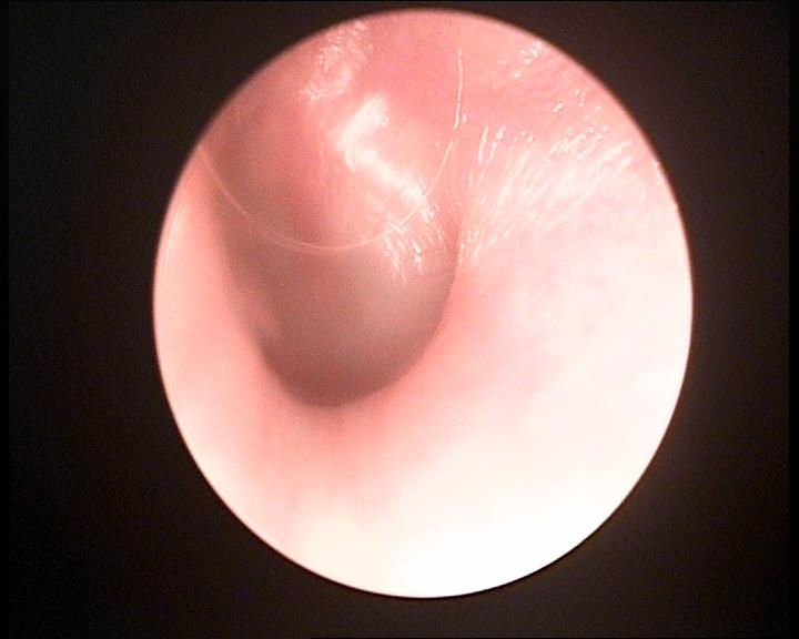 Otitis Media Aguda