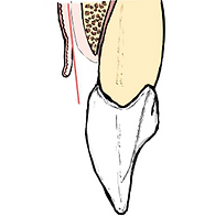 Detection of Sub-Gingival Calculus