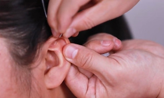Auriculotherapy