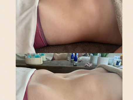Manual Lymphatic Drainage to helps with symptoms of IBS