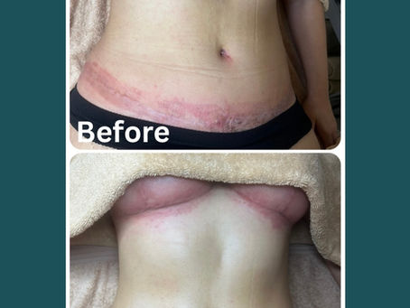 Post surgery Lymphatic Drainage massage