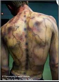Mange med sykdommen fibromyalgi lever i et smertehelvete