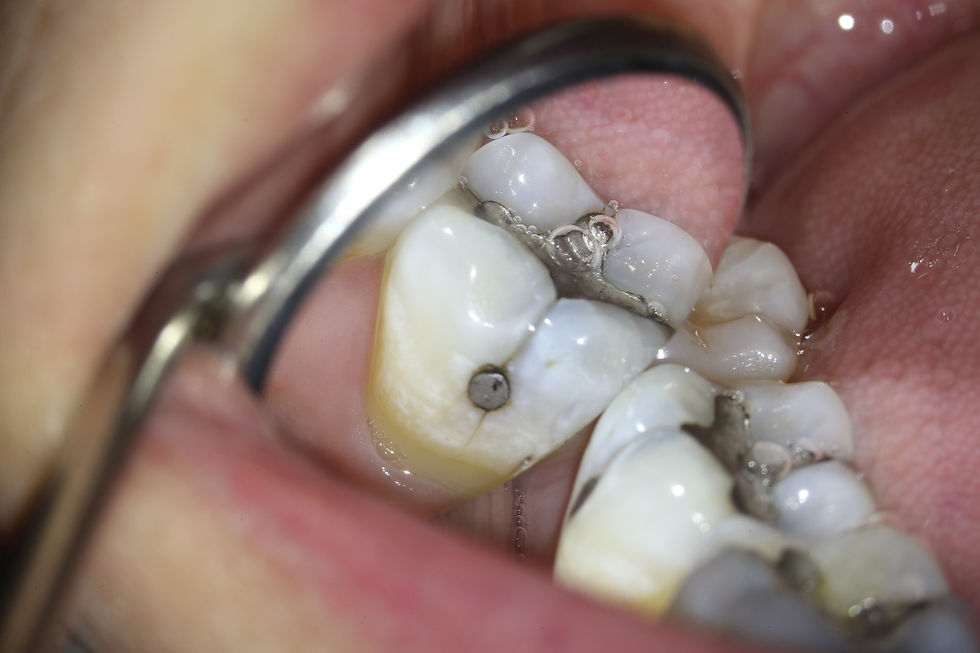 Trincas nos dentes: o que as restaurações de amálgama e o apertamento dentário têm a ver com isso?